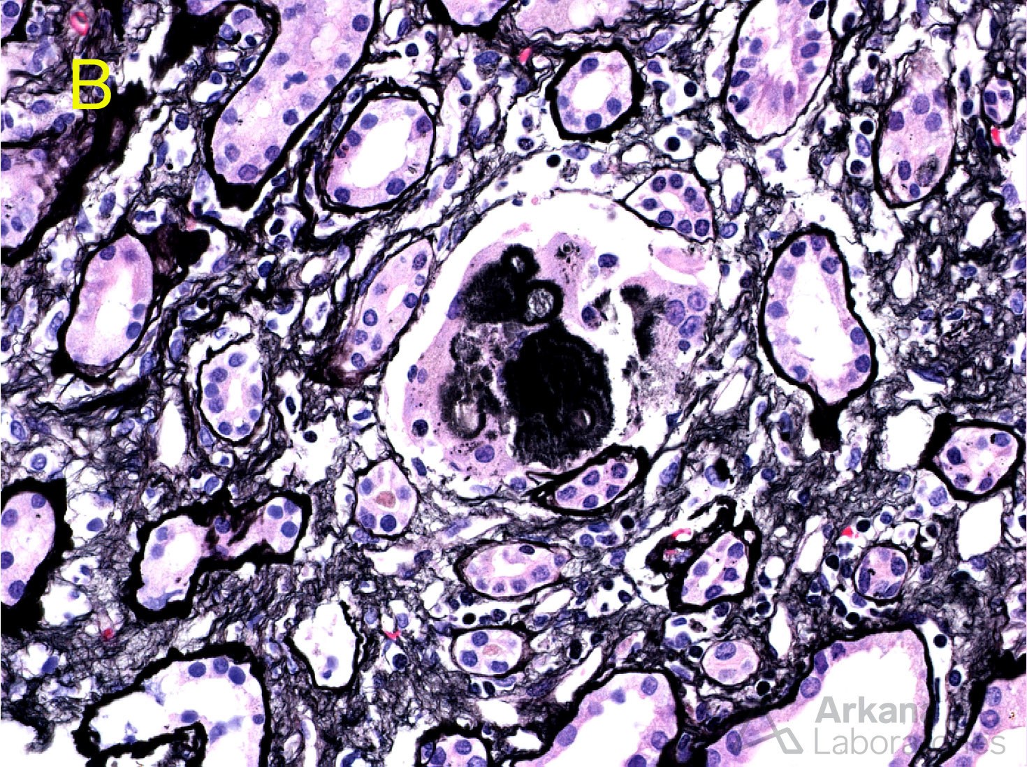 2,8 DHA Crystalline Nephropathy