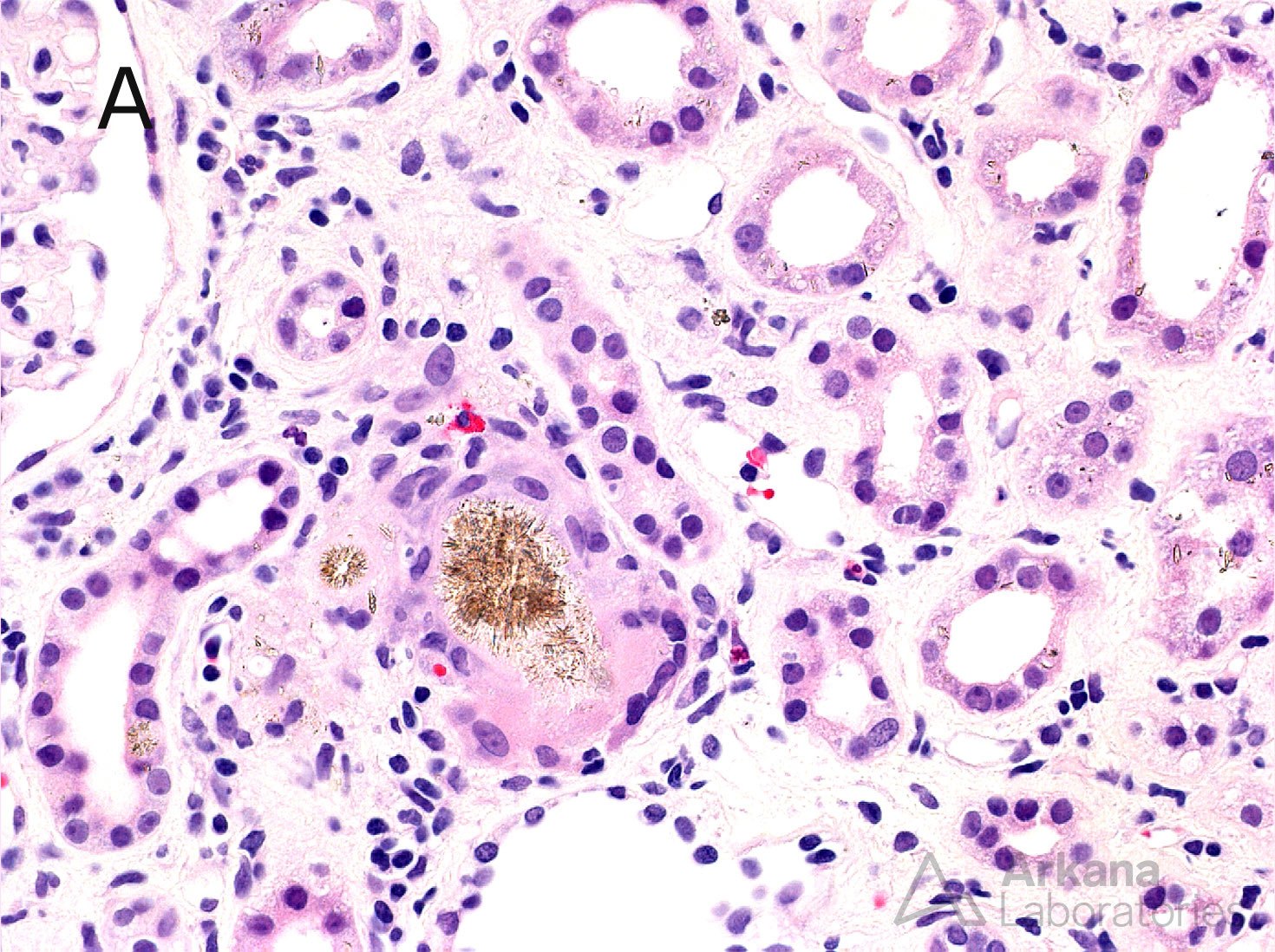 2,8 DHA Crystalline Nephropathy