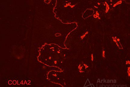 X-linked Alport syndrome