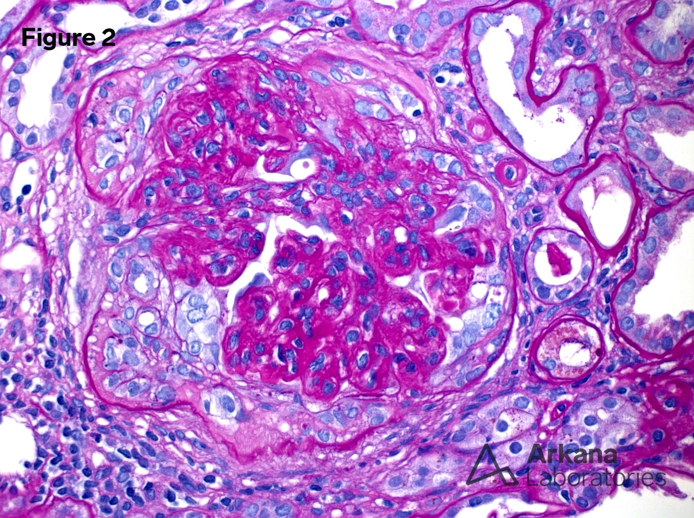 Proliferative Glomerulonephritis with Monoclonal IgG Deposits (PGMID)