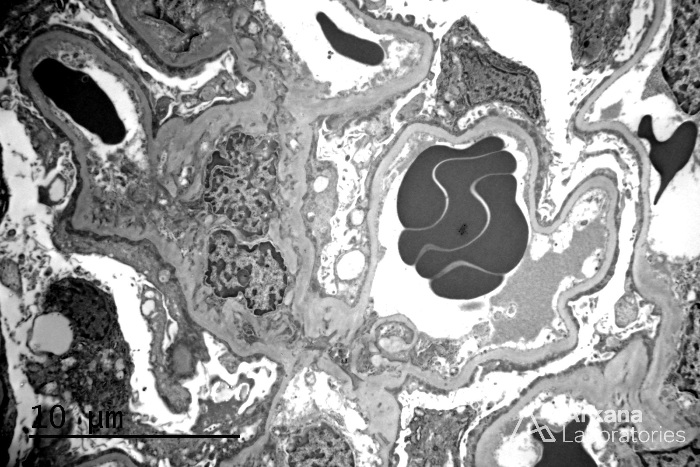 Diffuse and complete foot process effacement, Minimal Change Disease and New Onset DM Type I