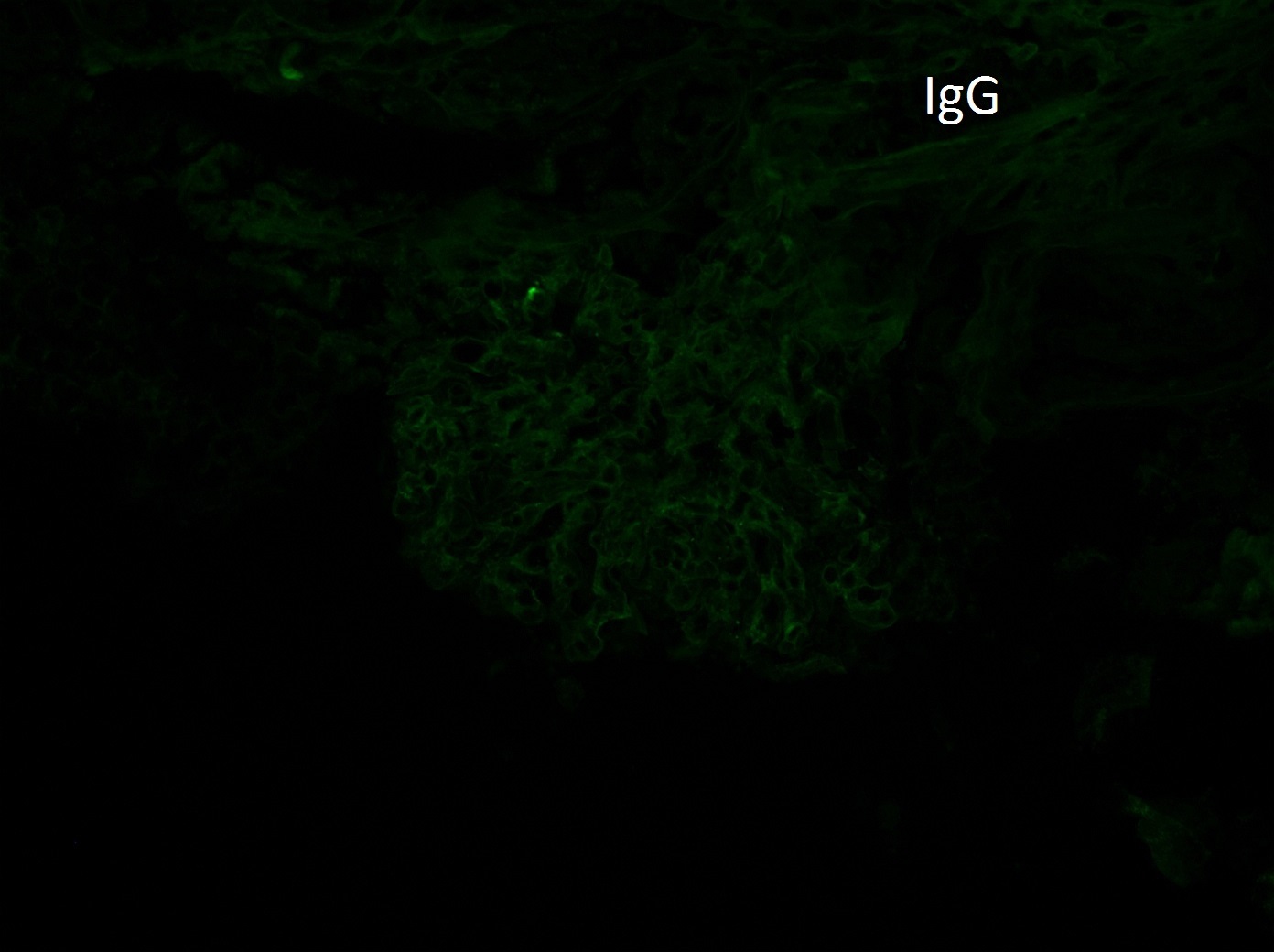 Membranous-like Glomerulopathy with Masked IgG Kappa Deposits