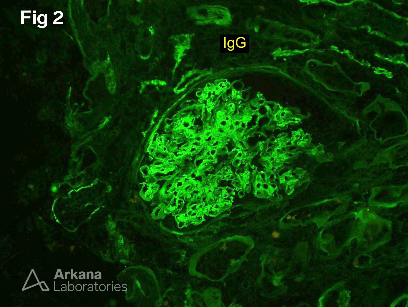 Fibrillary Glomerulopathy, IgG predominantly mesangial but with extension into loops