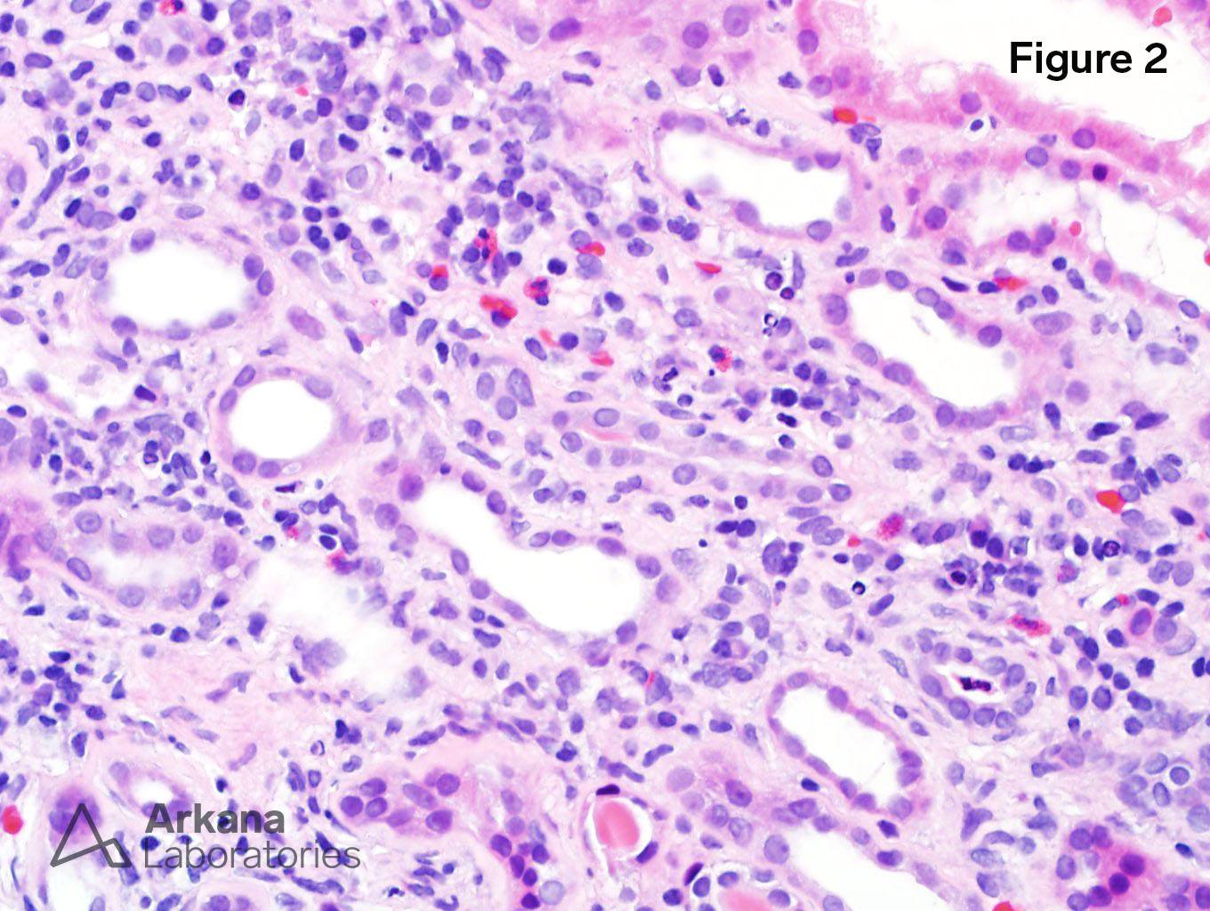 Chronic Active Tubulointerstitial Nephritis