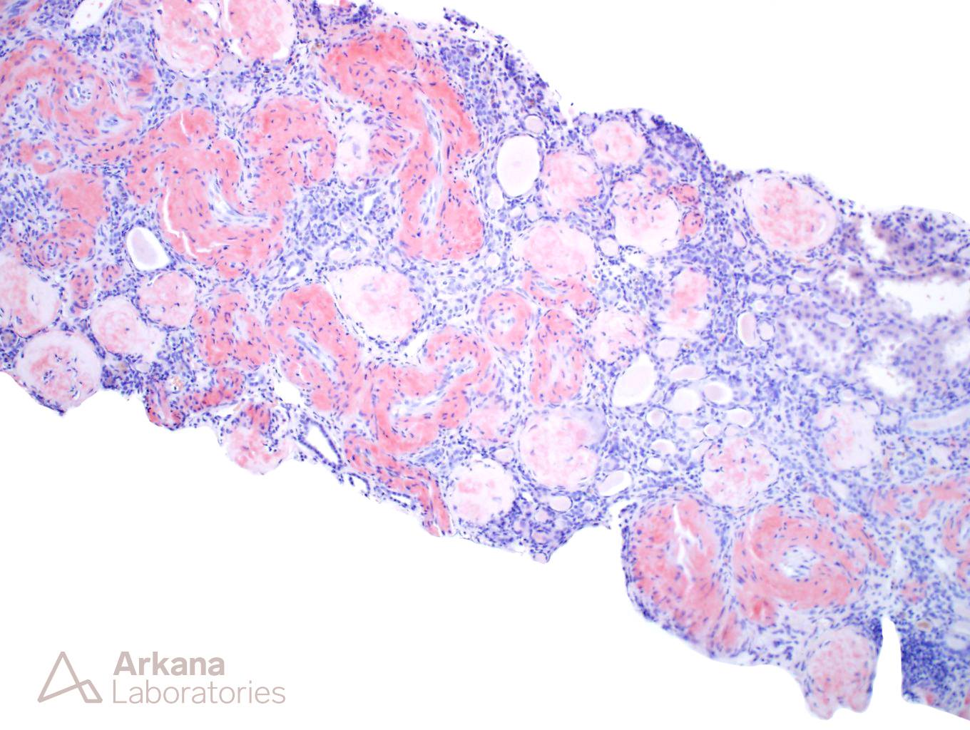 renal cortex showing Amyloidosis