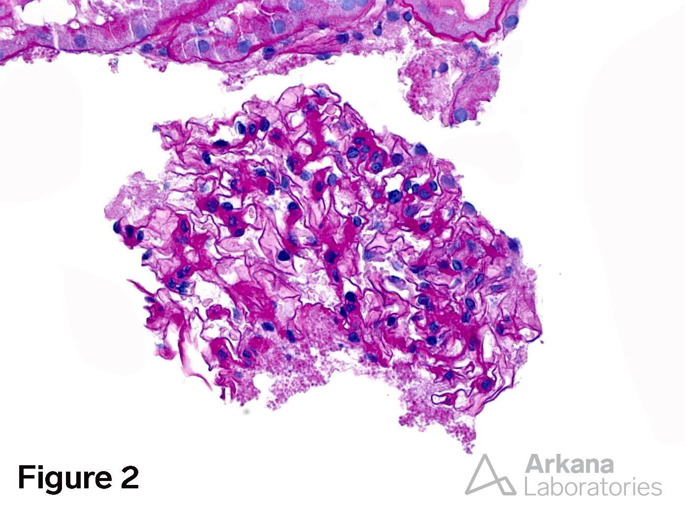 Acute Tubular Injury with Legionella