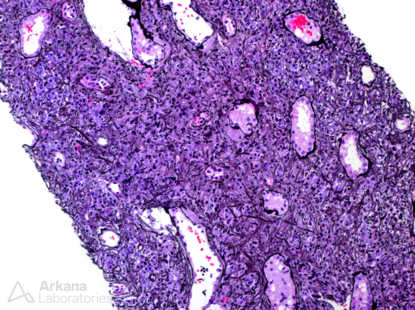 IgG4-related disease