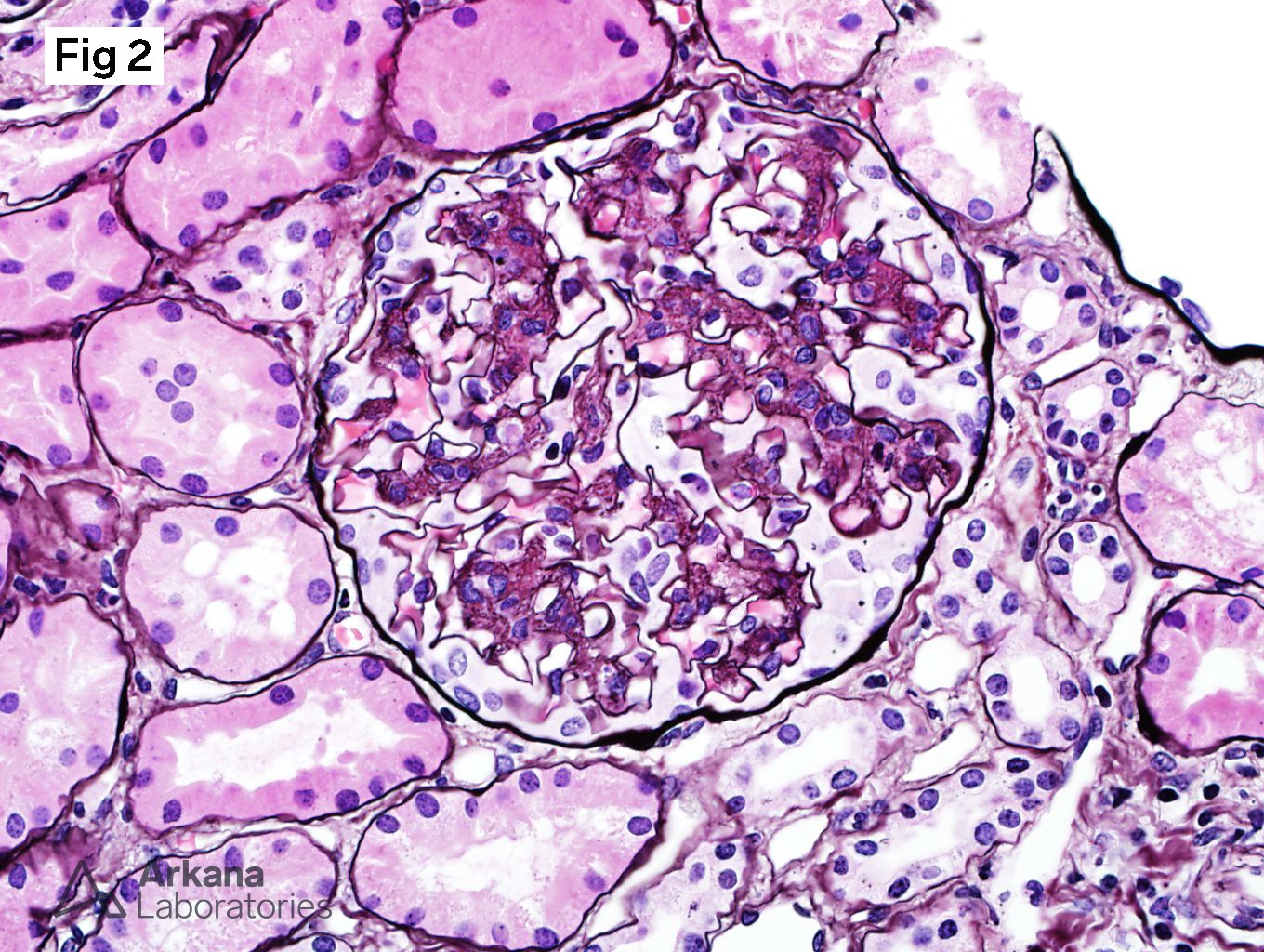 Mesangial matrix expansion and mesangial hypercellularity