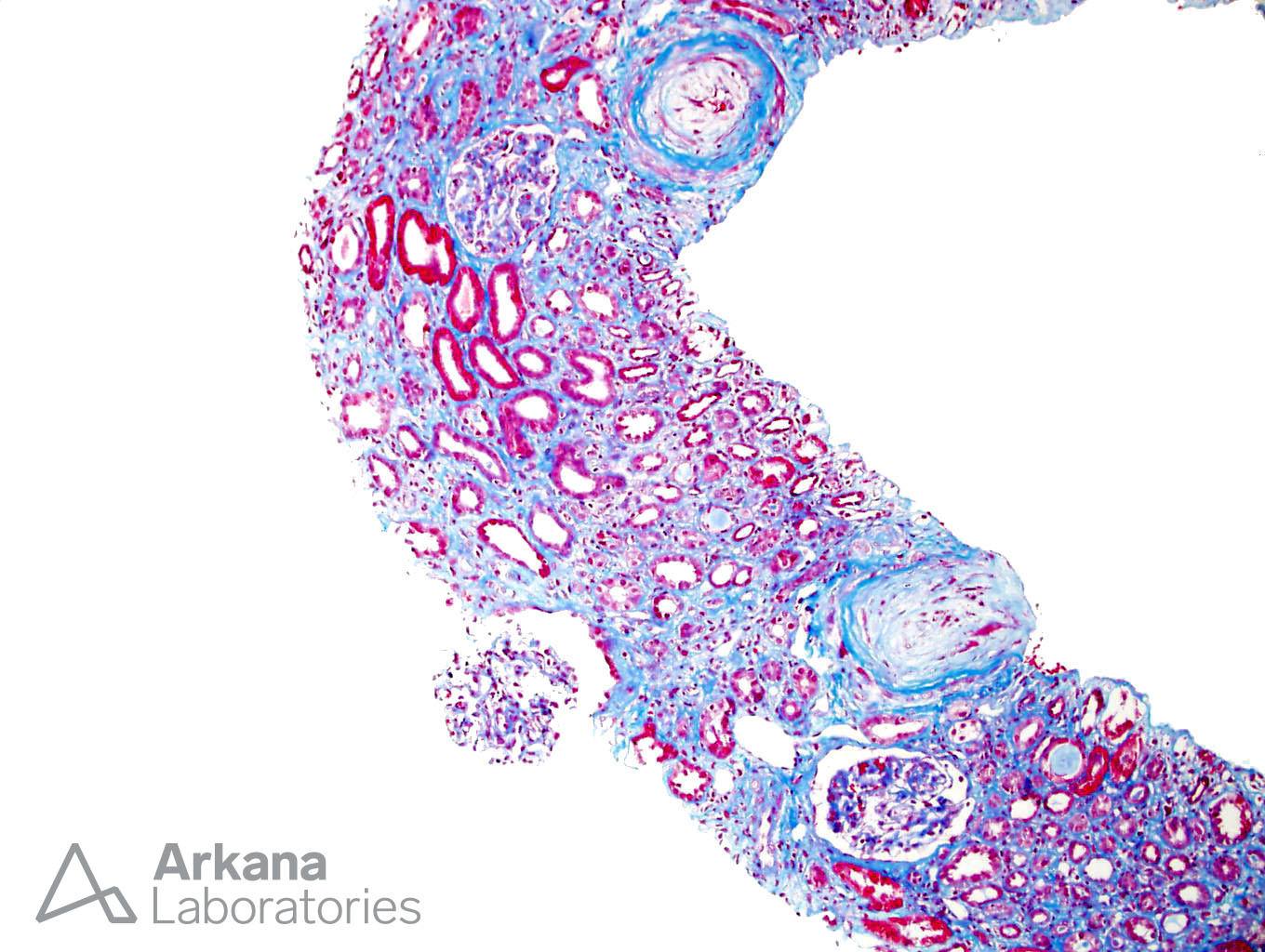 Thrombotic Microangiopathy