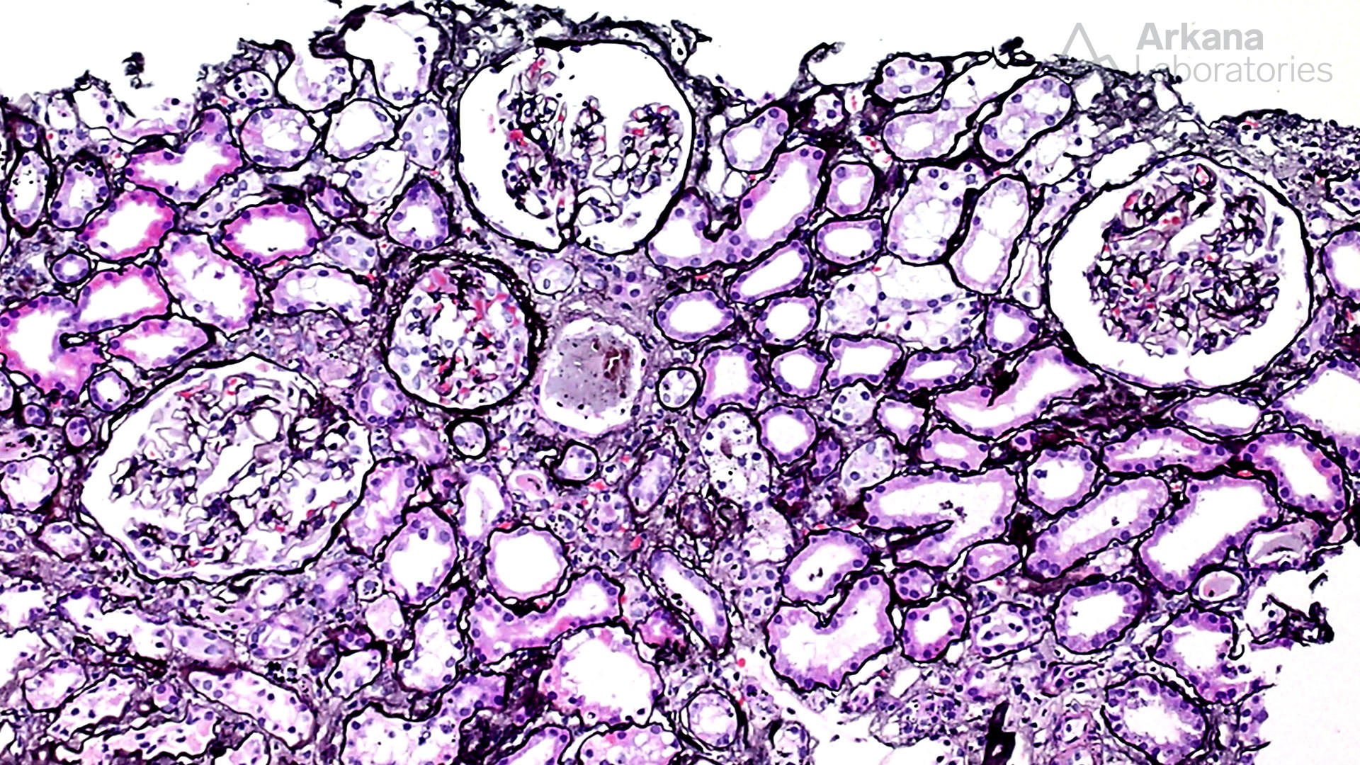 a-galactosidase A