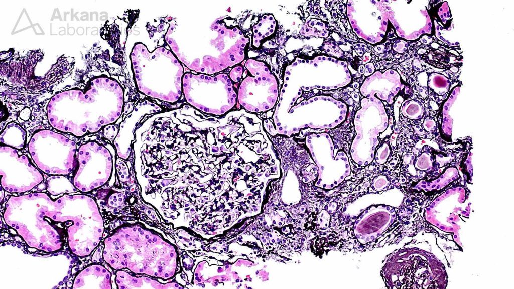 Lithium-Induced Nephropathy, pathology, renal education