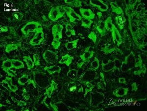 Light Chain Deposition Disease and Light Chain Proximal Tubulopathy