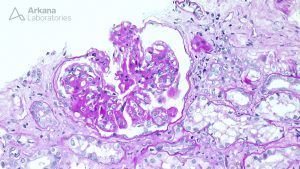 Fibrillary glomerulopathy