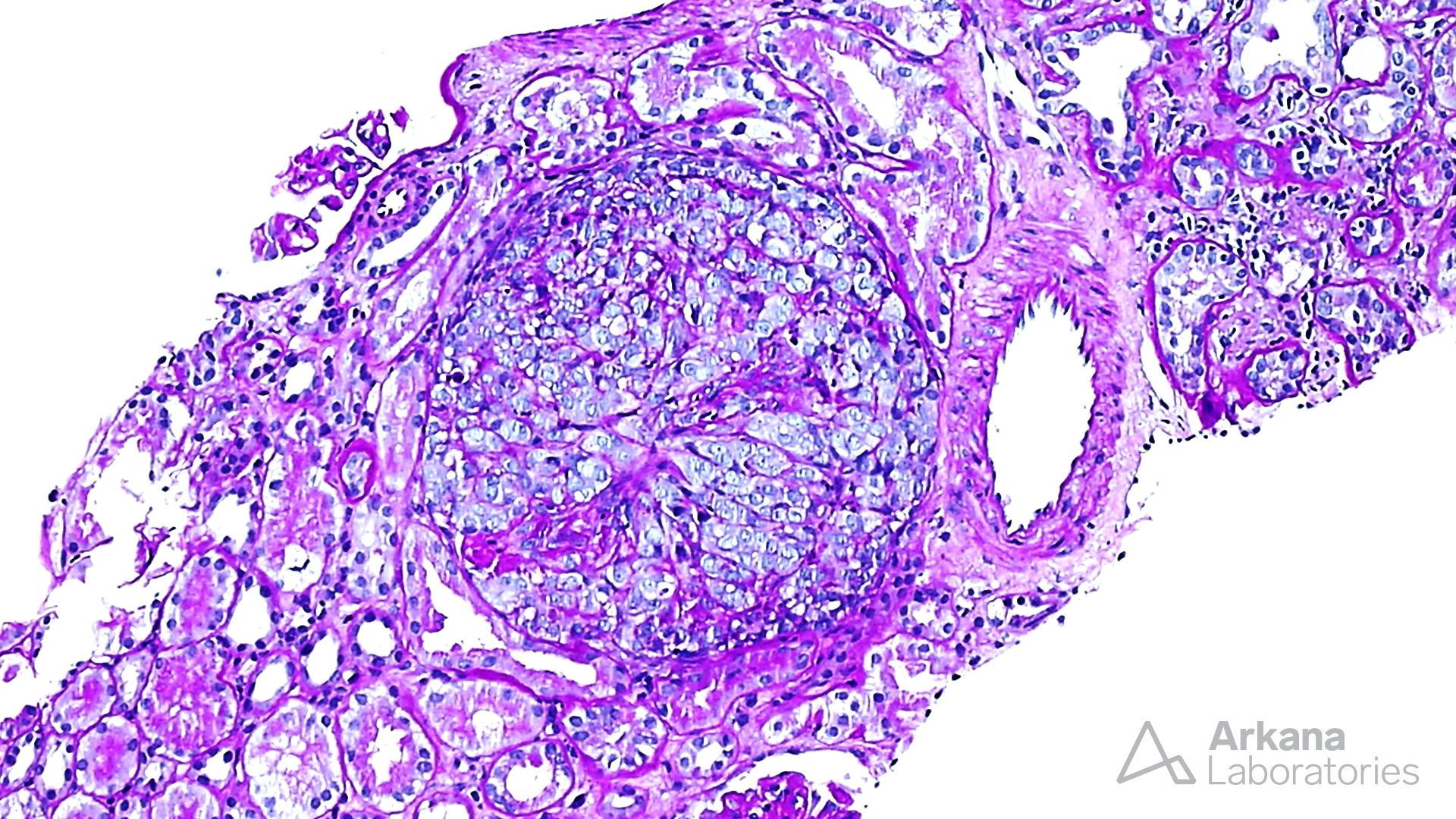 Dense deposit disease