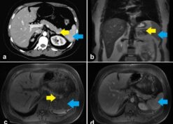 Contrast-enhanced axial CT Scan showing intra-pancreatic lesion in the tail of the pancreas isoattenuating compared to spleen