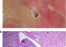 This arcuate vein contains tumor