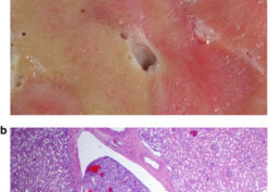 This arcuate vein contains tumor