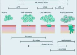 Adenoma-carcinoma sequence
