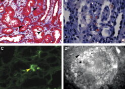 Amyloid proximal tubulopathy