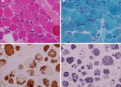 Muscle biopsy specimen, light microscopy