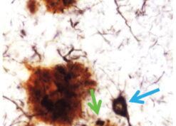 Photomicrograph of a section from the cerebral neocortex of an Alzheimer disease brain