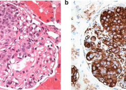 Intra-glomerular metastases