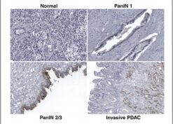 Representative immunohistochemical staining of KLK7 in human pancreatic tissues