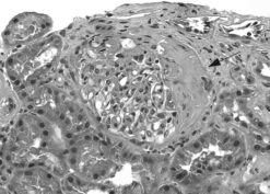 fibrous glomerular crescent that at an earlier stage was composed of proliferating parietal epithelial cells, inflammatory cells, and fibrin