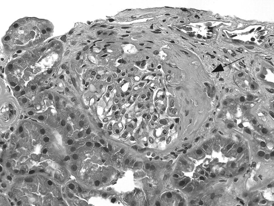 fibrous glomerular crescent that at an earlier stage was composed of proliferating parietal epithelial cells, inflammatory cells, and fibrin