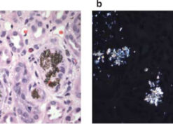 2,8-Dihydroxyadeninuria disease