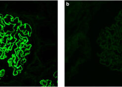 Phospholipase A2 receptor (PLA2R1 staining in membranous glomerulopathy