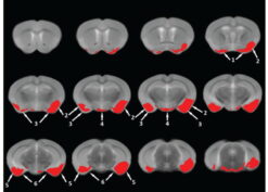 GT-tg mice treated with Dox (5 days) exhibited gray matter density reductions in several brain areas