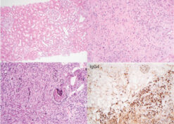 IgG4-related tubulointerstitial nephritis (TIN)