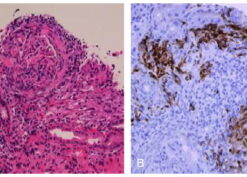 Renal interstitial involvement by angiomyolipoma