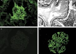 PLA2R1 staining in a case of recurrent MG
