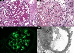 Diabetic nephropathy with superimposed IgA nephropathy