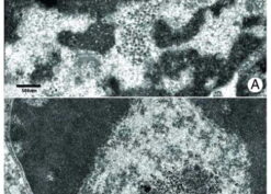 High-grade carcinoma from University of North Carolina archives demonstrating nuclear granules