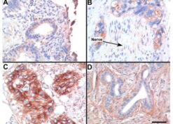 Expression of CD109 in Pancreatic Adenocarcinoma