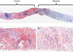 Leukocyte chemotactic factor 2 amyloidosis