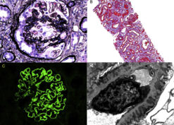 Collapsing glomerulopathy in a patient with PLA2R-positive membranous glomerulopathy