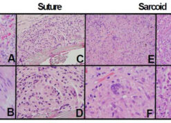 Histology suture, sarcoid, and infectious granulomata