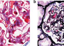 Glomerular deposits in membranous-like glomerulopathy with masked IgG-κ deposits