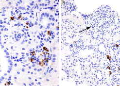 Immunohistochemical detection of B7-1 in a biopsy specimen from a patient with recurrent nephrotic syndrome after transplantation