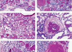 Renal biopsy findings in African Americans with hypertension, nephrosclerosis, and stage ≥ 3 CKD