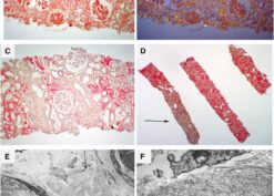 Renal pathology in amyloidosis derived from leukocyte cell–derived chemotaxin 2 (ALECT2) amyloidosis