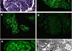 Light and immunofluorescence microscopic findings in a case of membranoproliferative glomerulonephritis with masked immunoglobulin G (IgG) kappa deposits