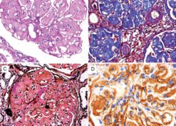 Morphology of collagenofibrotic glomerulopathy