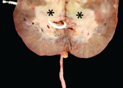Allograft nephrectomy specimen, bivalved