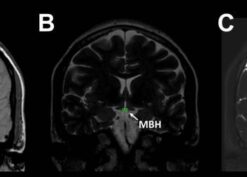 Measurement of T2 relaxation time