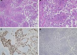 Histology of renal allograft tumor, formalin-fixed paraffin-embedded tissue